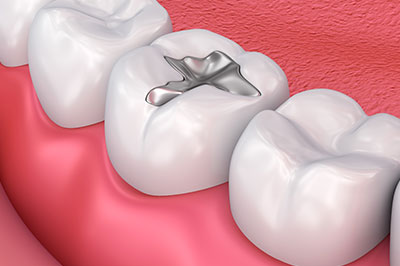 The image shows a close-up view of a human tooth with an implant visible on its surface, set against a background that appears to be a dental setting with a pink floor and a red wall.