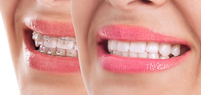 The image shows a close-up of a person s smiling face with pink lipstick, displaying their teeth and facial features.