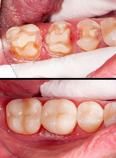 The image shows a close-up view of a person s mouth with teeth that appear damaged and possibly undergoing dental treatment, with two different stages of care depicted side by side.