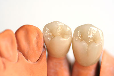 A close-up photograph of two dental implants with visible screws, set against a white background.