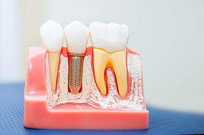 The image shows a dental model with multiple teeth, some of which have crowns and fillings, placed on a pink base that resembles a mouth and jaw structure.