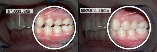 The image displays two photographs side by side  on the left, an oral cavity with teeth showing signs of decay and gum disease  on the right, a close-up view of the same mouth after dental treatment, highlighting improved oral hygiene and dental health.