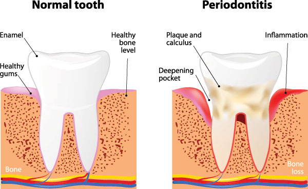 The image is a medical illustration showing different stages of tooth decay progression from normal to severe, accompanied by text explaining the process and the stages labeled  normal,   periodontitis,  and  bone loss.