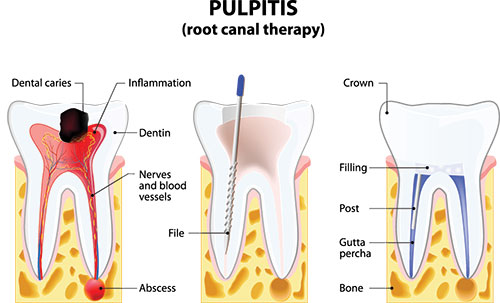 The image shows a detailed illustration of a tooth with pulpitis, labeled with various parts such as dental caries, inflammation, and a blue filling tool, highlighting the anatomical features and treatment process for this condition.