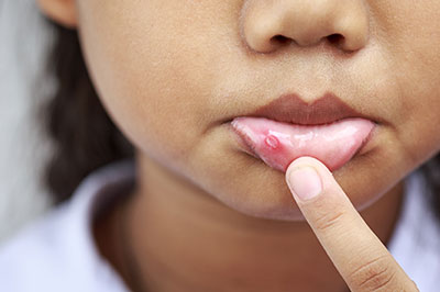 The image shows a close-up of a person s face with a focus on their lips, which appear to be cracked or chapped.