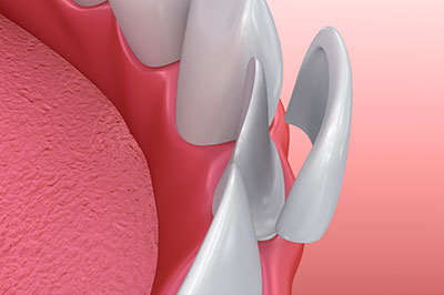 The image displays a close-up view of a dental implant with a pink gum background, showcasing the metallic implant post and surrounding tissue.