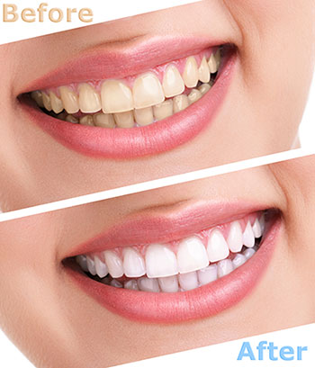 The image displays a before-and-after comparison of teeth whitening results, featuring a person s smiling mouth with a noticeable difference in tooth color between the two images.