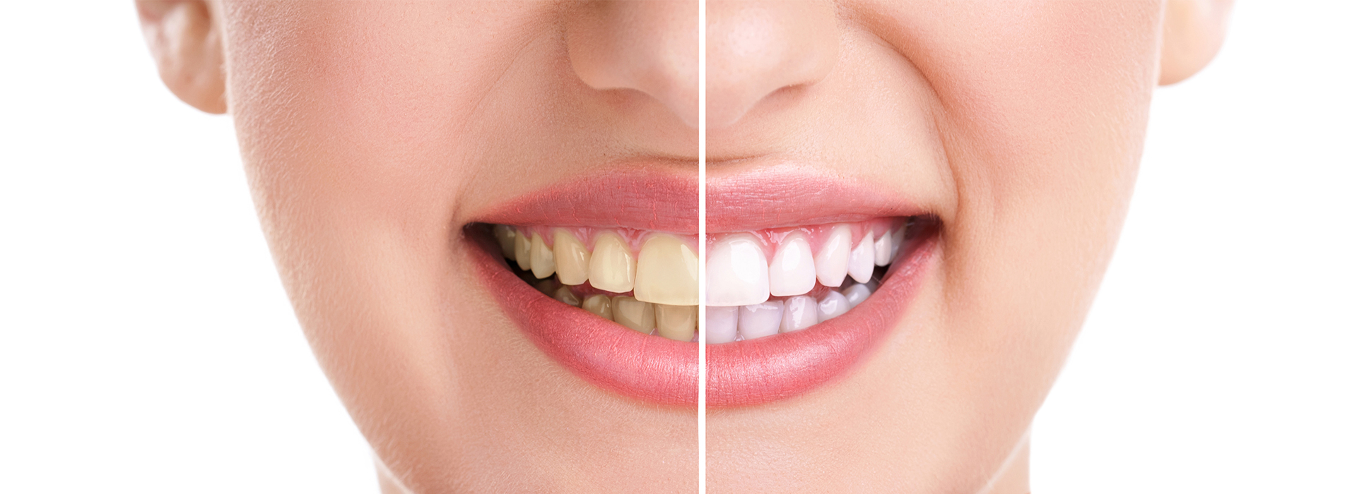 The image shows a close-up of a person s face with a focus on their teeth and mouth, highlighting a dental treatment process.