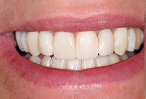 The image shows a close-up of a person s smile with straight white teeth.