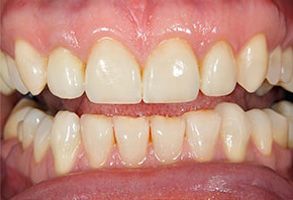 The image shows a close-up view of a person s teeth with visible staining and discoloration, suggesting poor oral hygiene.