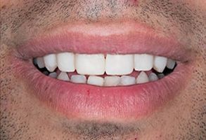 The image shows a close-up view of a person s smiling mouth with white teeth, displaying a wide smile, against a neutral background.