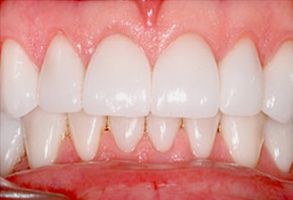 The image displays a close-up view of a person s teeth with a focus on the upper front teeth, which appear to be straight and well-maintained, against a background that seems to be a medical setting due to the presence of a sterile environment and a piece of dental equipment.