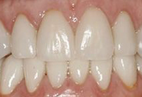 The image shows a close-up view of a person s teeth with a focus on a cosmetic dental treatment, likely braces or aligners, used for orthodontic purposes.