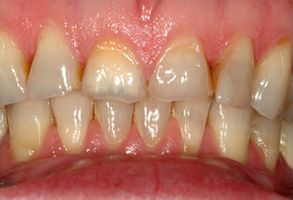 The image shows a close-up view of a person s teeth with visible yellowing and staining, indicating possible dental issues such as discoloration or decay.